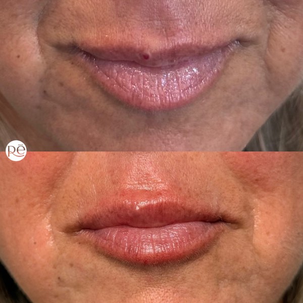 Dermal and lip filler result 15 at ReViVe Aesthetics & Healthcare