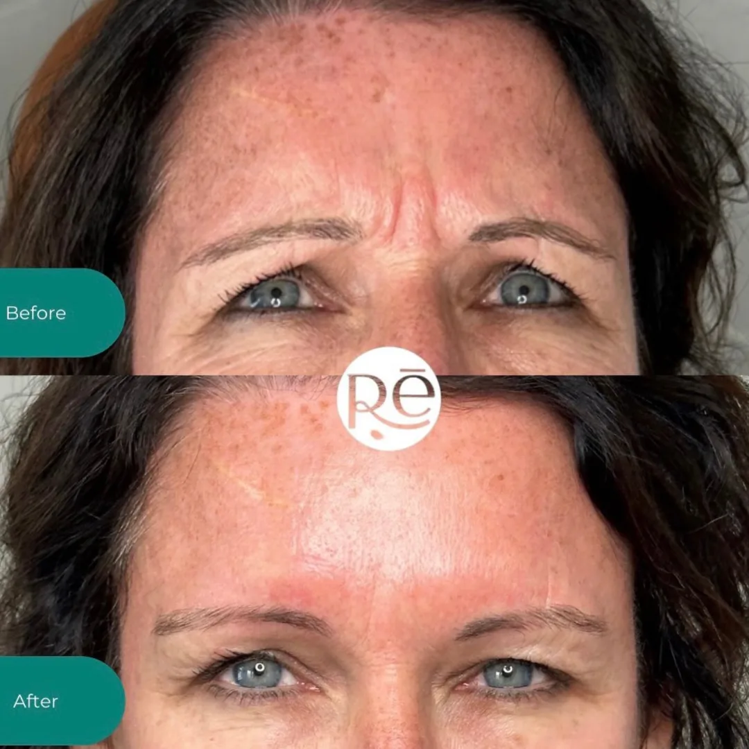Real Botox before and after results at ReViVe Aesthetics
