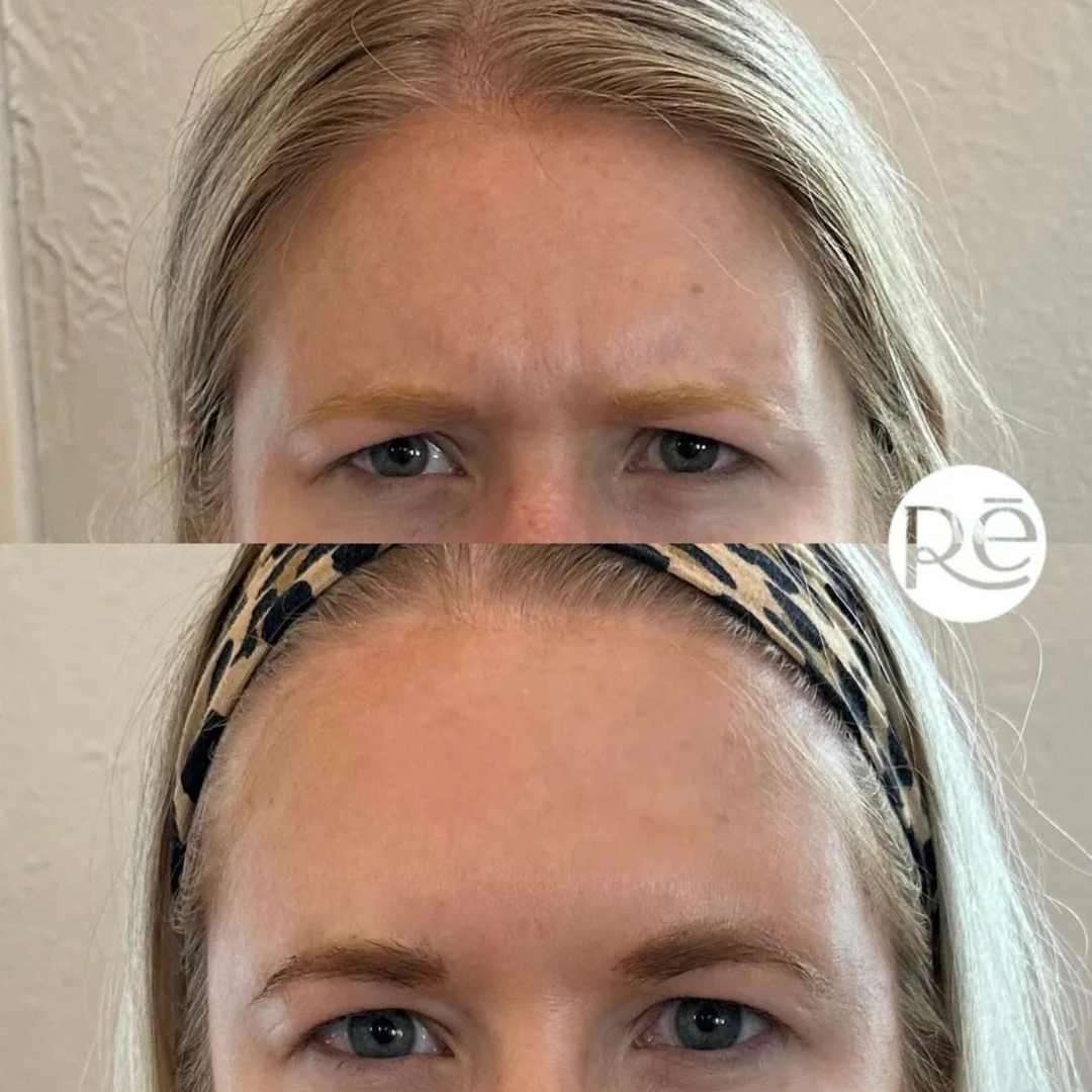 Real Dysport before and after results at ReViVe Aesthetics