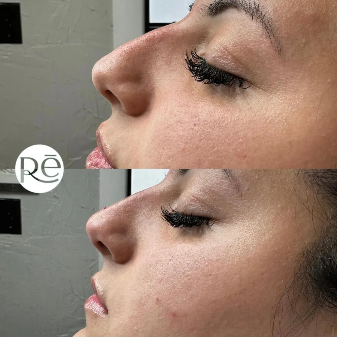 Real Nose Filler before and after results at ReViVe Aesthetics