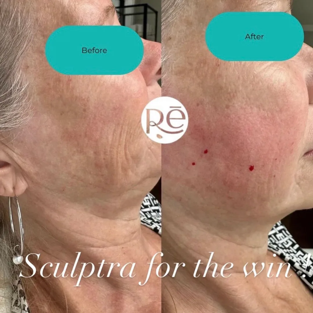 Real Sculptra before and after results at ReViVe Aesthetics